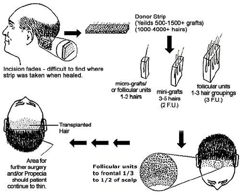 Hair Transplant Graft Chart