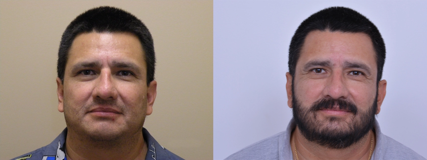 male facial hair transplant results before and after