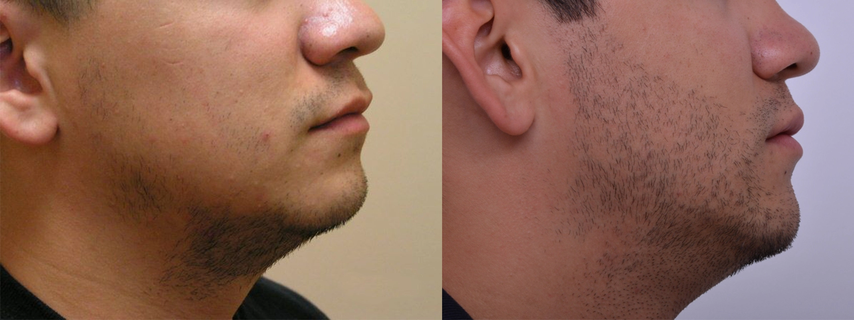 male facial hair transplant results before and after