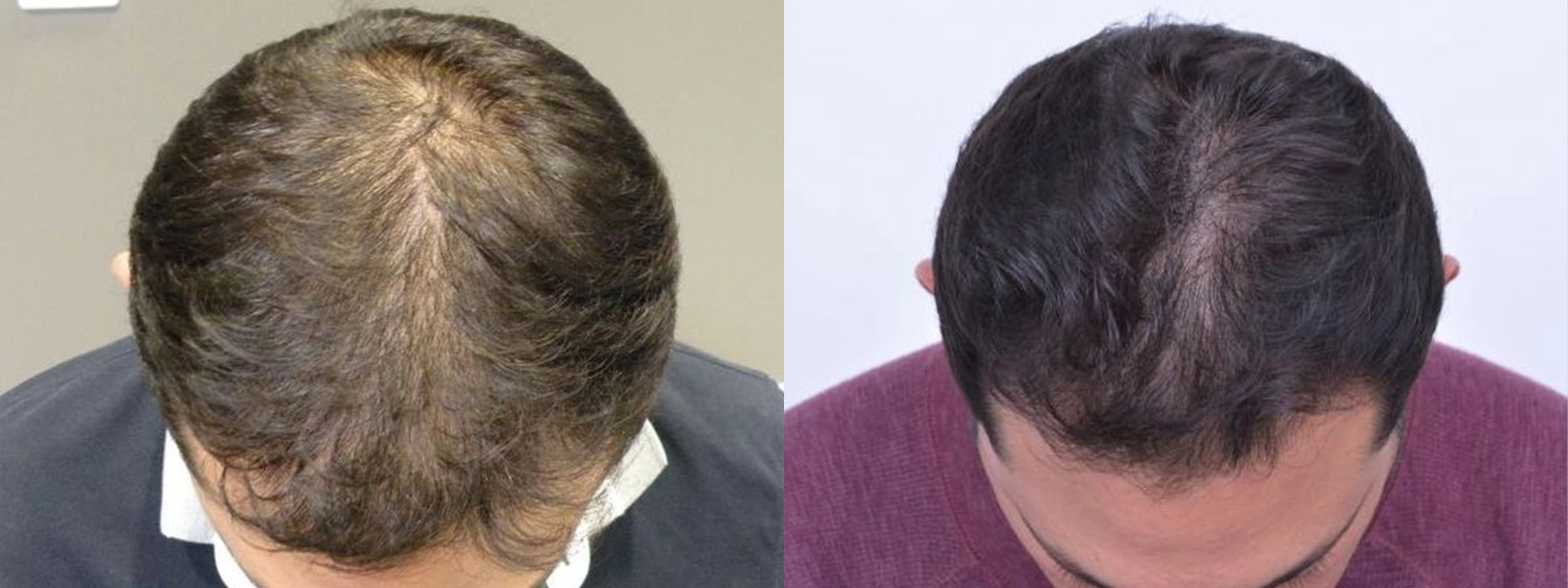 male laser hair therapy results before and after