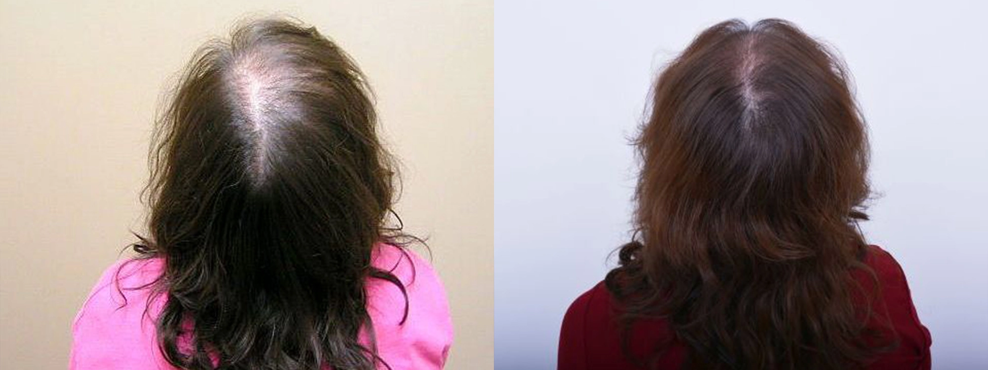 female laser hair therapy results before and after