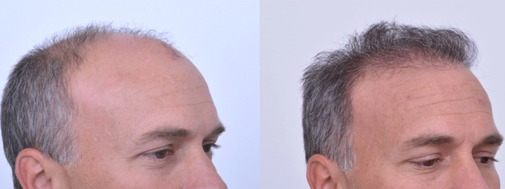 male hair transplant results before and after