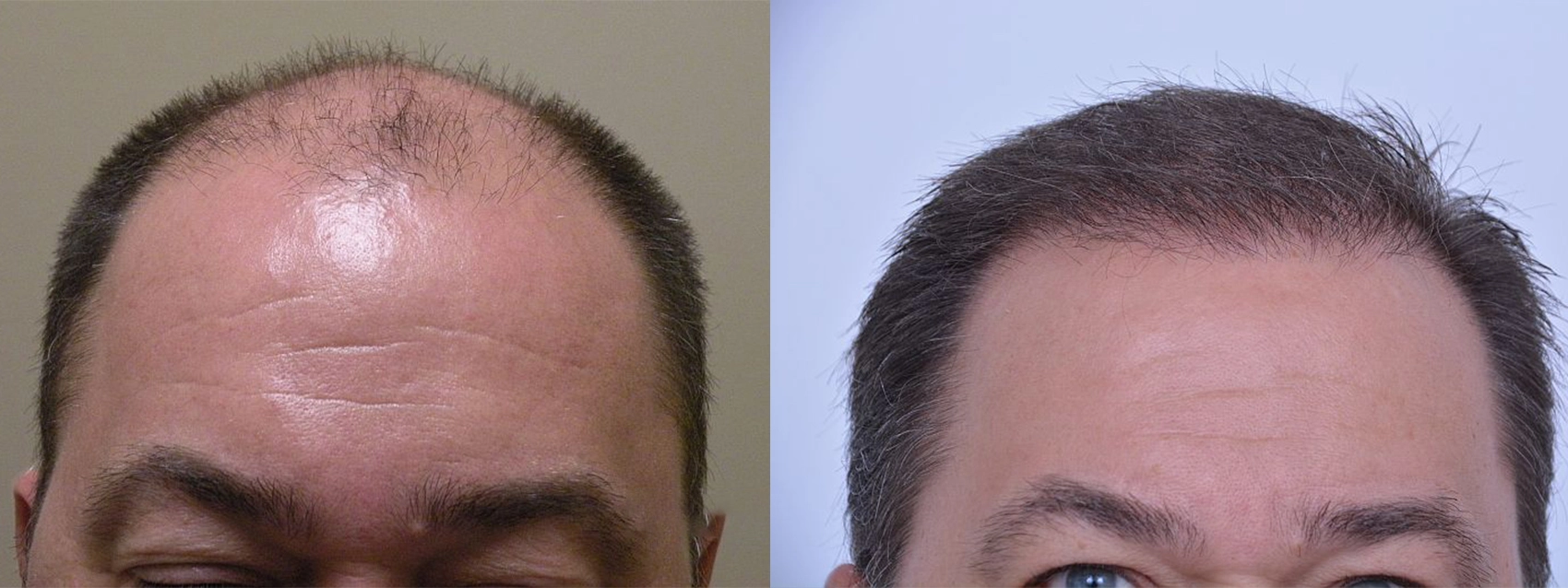male hair transplant results before and after