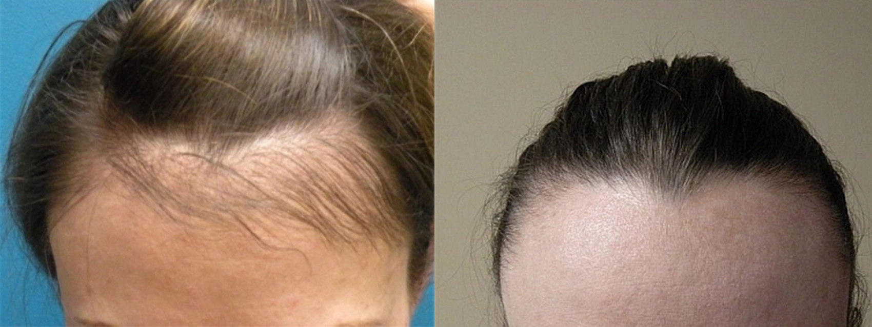 female hair transplant results before and after