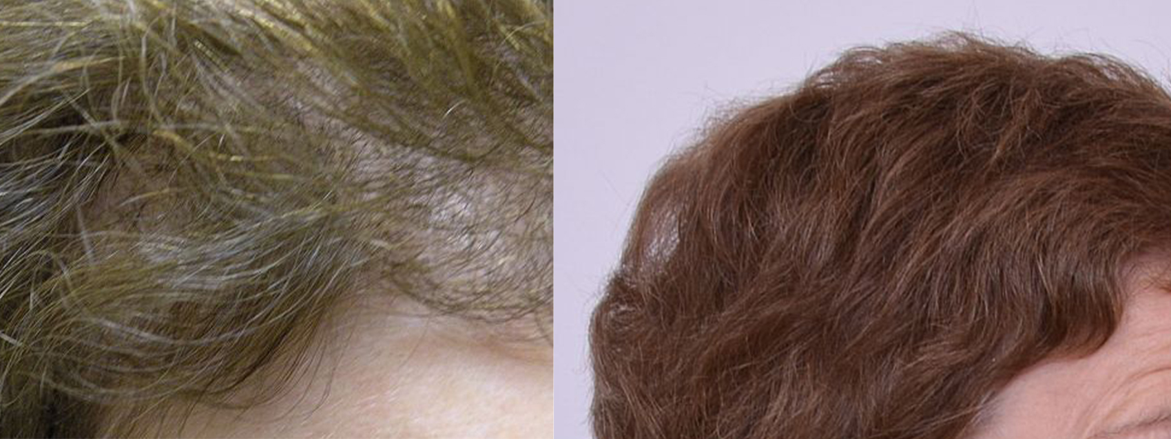 female hair transplant results before and after