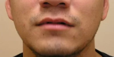 beard-before-and-after-patient-2-a beard-before-and-after-patient-2-a