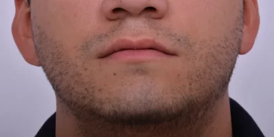 beard-before-and-after-patient-2-b beard-before-and-after-patient-2-b