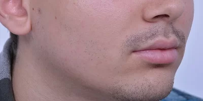 beard-before-and-after-patient-3-a beard-before-and-after-patient-3-a
