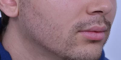beard-before-and-after-patient-3-b beard-before-and-after-patient-3-b