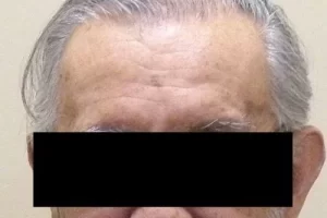 laser-therapy-before-and-after-patient-1-a laser-therapy-before-and-after-patient-1-a