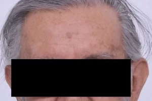 laser-therapy-before-and-after-patient-1-b laser-therapy-before-and-after-patient-1-b
