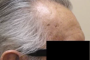 laser-therapy-before-and-after-patient-1-c laser-therapy-before-and-after-patient-1-c