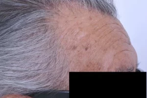 laser-therapy-before-and-after-patient-1-d laser-therapy-before-and-after-patient-1-d