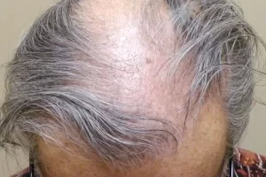 laser-therapy-before-and-after-patient-1-e laser-therapy-before-and-after-patient-1-e