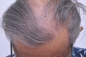 laser-therapy-before-and-after-patient-1-f laser-therapy-before-and-after-patient-1-f