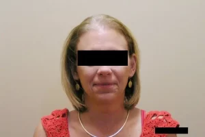laser-therapy-before-and-after-patient-10-a laser-therapy-before-and-after-patient-10-a