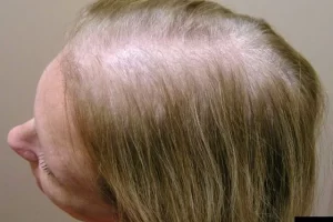 laser-therapy-before-and-after-patient-10-c laser-therapy-before-and-after-patient-10-c