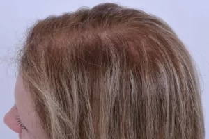 laser-therapy-before-and-after-patient-10-d laser-therapy-before-and-after-patient-10-d