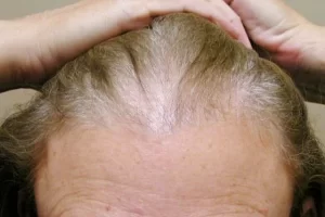 laser-therapy-before-and-after-patient-10-e laser-therapy-before-and-after-patient-10-e