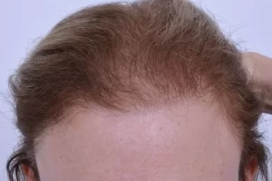 laser-therapy-before-and-after-patient-10-f laser-therapy-before-and-after-patient-10-f