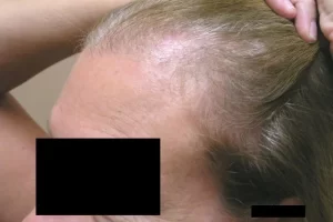 laser-therapy-before-and-after-patient-10-g laser-therapy-before-and-after-patient-10-g