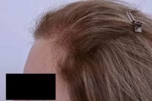 laser-therapy-before-and-after-patient-10-h laser-therapy-before-and-after-patient-10-h