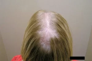 laser-therapy-before-and-after-patient-10-i laser-therapy-before-and-after-patient-10-i