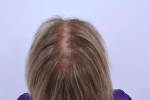 laser-therapy-before-and-after-patient-10-j laser-therapy-before-and-after-patient-10-j