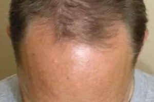 laser-therapy-before-and-after-patient-11-a laser-therapy-before-and-after-patient-11-a