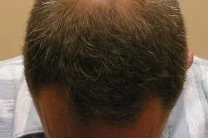 laser-therapy-before-and-after-patient-11-b laser-therapy-before-and-after-patient-11-b