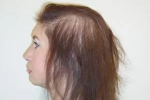 laser-therapy-before-and-after-patient-12-a laser-therapy-before-and-after-patient-12-a
