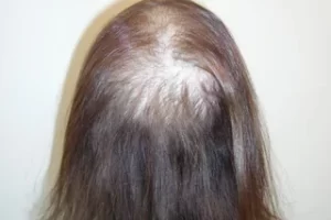 laser-therapy-before-and-after-patient-12-e laser-therapy-before-and-after-patient-12-e
