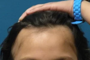 laser-therapy-before-and-after-patient-13-a laser-therapy-before-and-after-patient-13-a