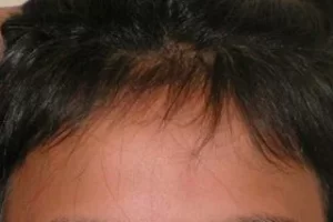 laser-therapy-before-and-after-patient-13-b laser-therapy-before-and-after-patient-13-b