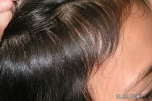 laser-therapy-before-and-after-patient-13-d laser-therapy-before-and-after-patient-13-d