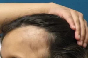 laser-therapy-before-and-after-patient-13-e laser-therapy-before-and-after-patient-13-e