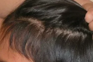 laser-therapy-before-and-after-patient-13-f laser-therapy-before-and-after-patient-13-f