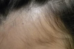 laser-therapy-before-and-after-patient-13-g laser-therapy-before-and-after-patient-13-g