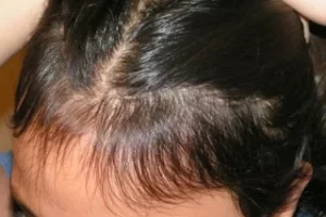 laser-therapy-before-and-after-patient-13-h laser-therapy-before-and-after-patient-13-h