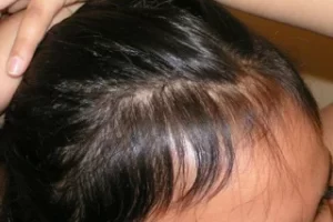 laser-therapy-before-and-after-patient-13-l laser-therapy-before-and-after-patient-13-l