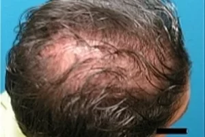 laser-therapy-before-and-after-patient-14-a laser-therapy-before-and-after-patient-14-a