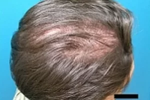laser-therapy-before-and-after-patient-14-b laser-therapy-before-and-after-patient-14-b