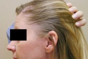 laser-therapy-before-and-after-patient-15-a laser-therapy-before-and-after-patient-15-a