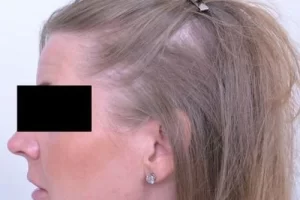 laser-therapy-before-and-after-patient-15-b laser-therapy-before-and-after-patient-15-b