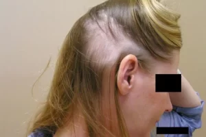 laser-therapy-before-and-after-patient-15-c laser-therapy-before-and-after-patient-15-c