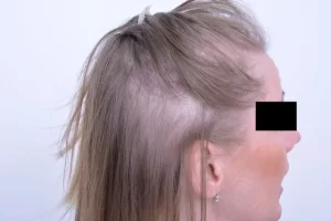 laser-therapy-before-and-after-patient-15-d laser-therapy-before-and-after-patient-15-d