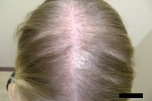 laser-therapy-before-and-after-patient-15-e laser-therapy-before-and-after-patient-15-e