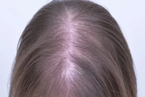 laser-therapy-before-and-after-patient-15-f laser-therapy-before-and-after-patient-15-f