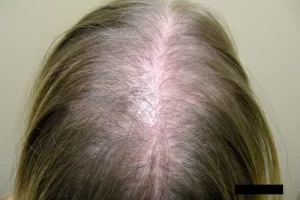 laser-therapy-before-and-after-patient-15-g laser-therapy-before-and-after-patient-15-g