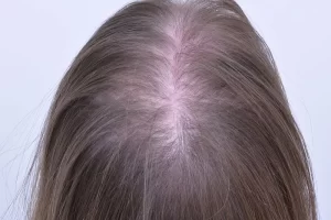laser-therapy-before-and-after-patient-15-h laser-therapy-before-and-after-patient-15-h